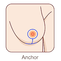 breast reduction anchor incision
