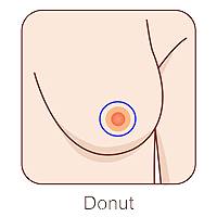breast reduction donut incision