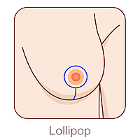 breast reduction lollipop incision