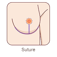 Breast Reduction surgery suture