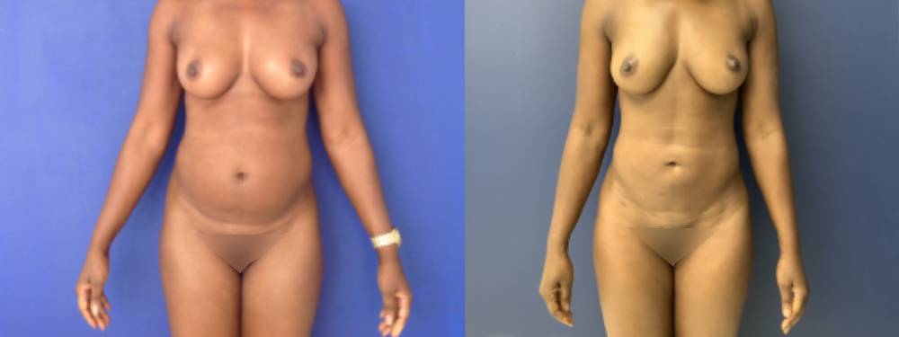 Liposuction Before And After Pictures