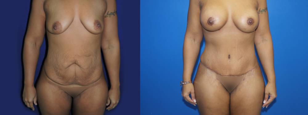 Tummy Tuck Before And After Pictures