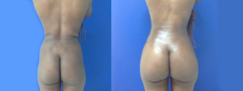 Brazilian Butt Lift Before And After Pictures