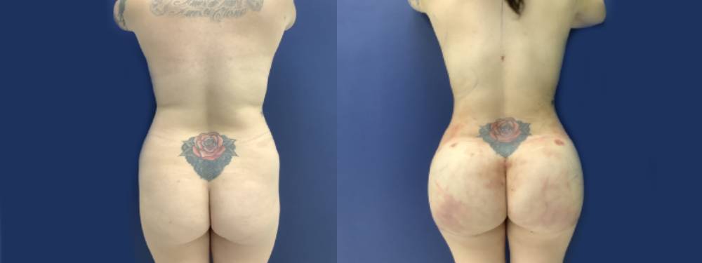 Brazilian Butt Lift Before And After Pictures