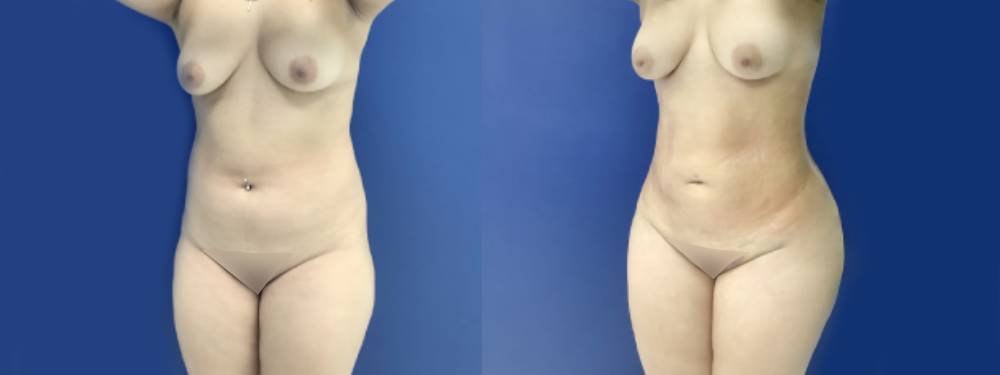 Liposuction Before And After Pictures