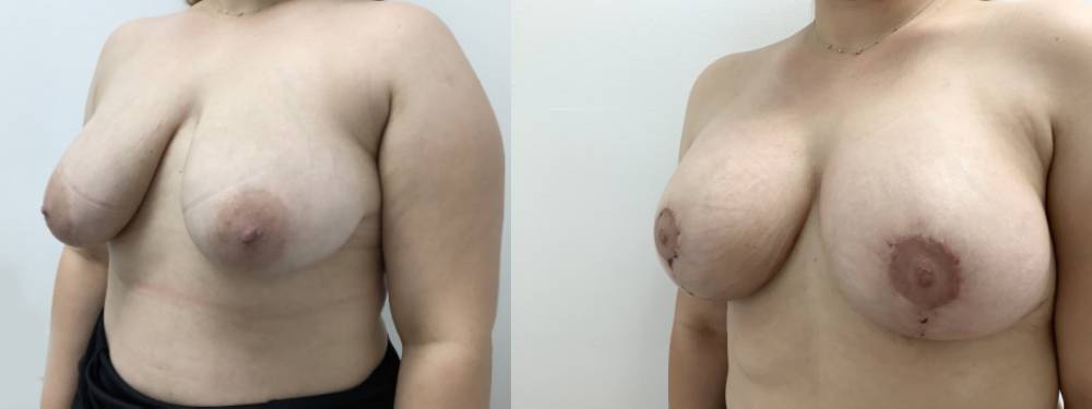 Breast Lift Before And After Pictures