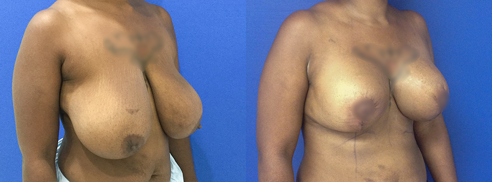 Breast Reduction Before And After Pictures