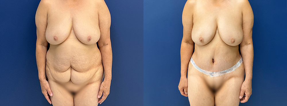 Tummy Tuck Before And After Pictures