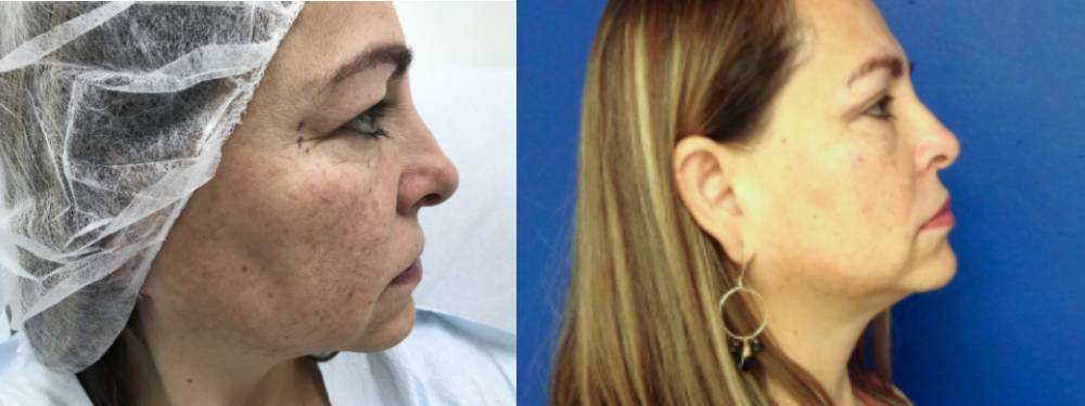Blepharoplasty Before And After Pictures