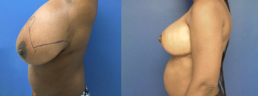 Breast Reduction Before And After Pictures