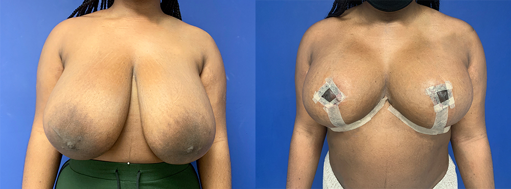 Breast Lift Before And After Pictures
