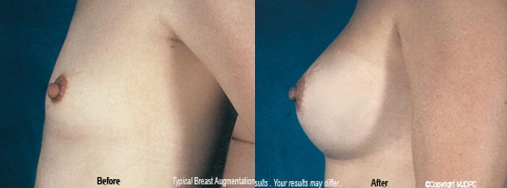 Breast Augmentation Before And After Pictures