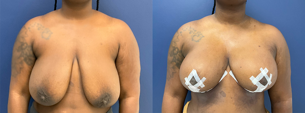 Breast Augmentation Before And After Pictures