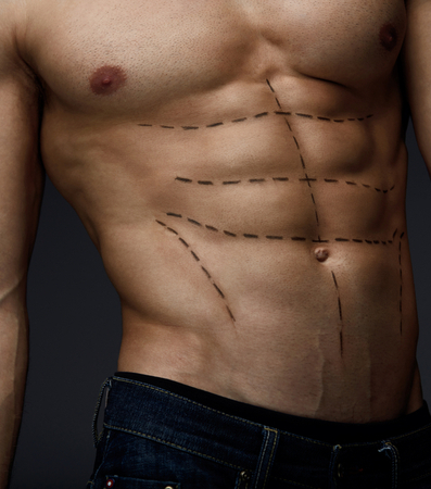 What is Ab Etching? Is it Worth the Surgery?